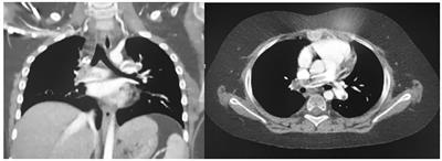 Vascular complications in craniopharyngioma-resected paediatric patients: a single-center experience